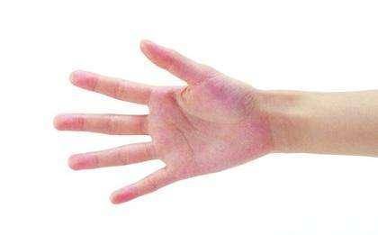 手脱皮好了又脱皮是什么原因,手脱皮是什么原因引起的怎么治疗