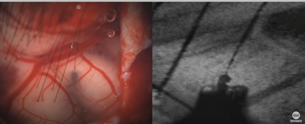 马斯克的脑控技术实际应用场景有哪些？瘫痪患者看到要兴奋了