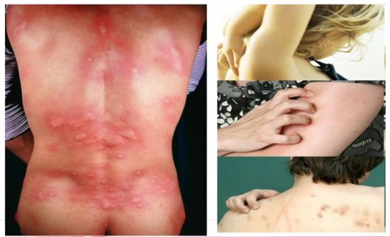 麻疹的诊断标准是什么,麻疹诊断