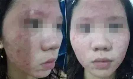 皮肤化妆品过敏最快缓解方法,皮肤过敏一定是化妆品的错吗