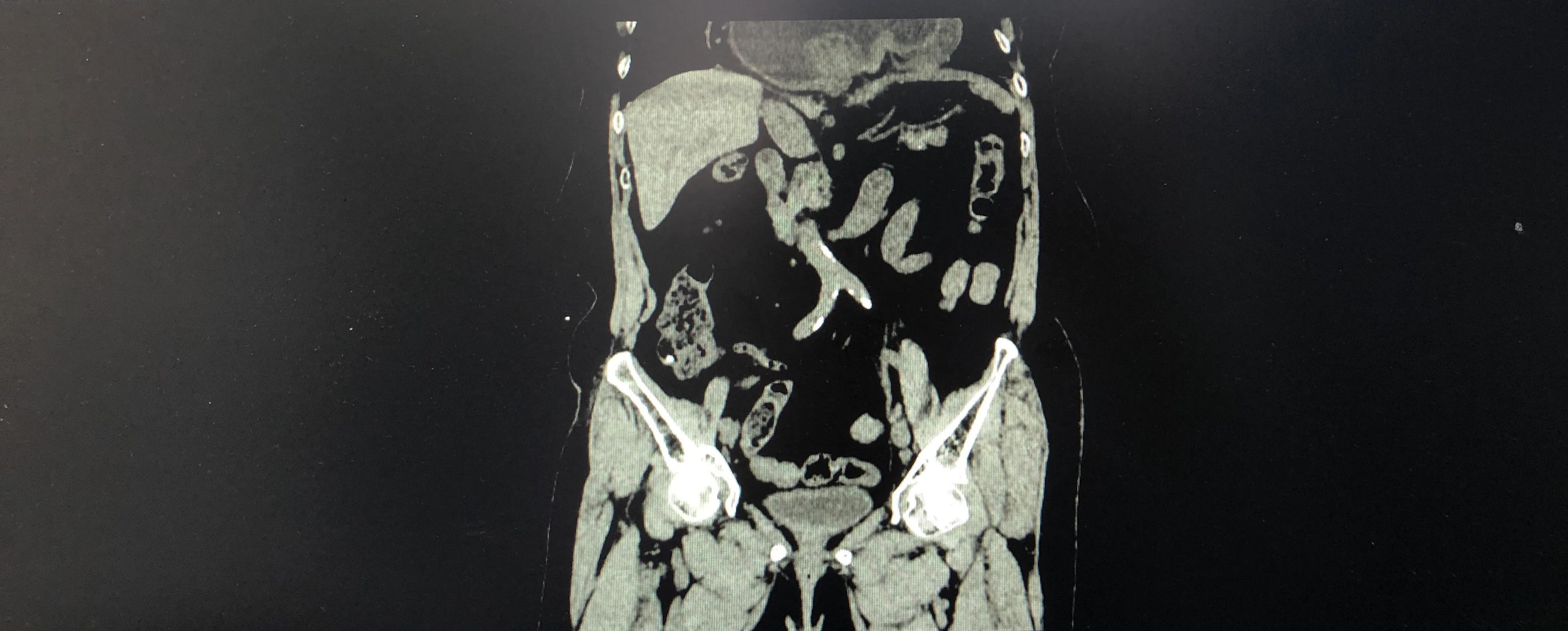 胃跑到胸腔了怎么办,胃跑到胸腔里做什么手术