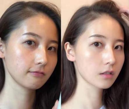 美容针变“毒针”，19岁女孩被毁容，医生：打针有风险跟风需谨慎