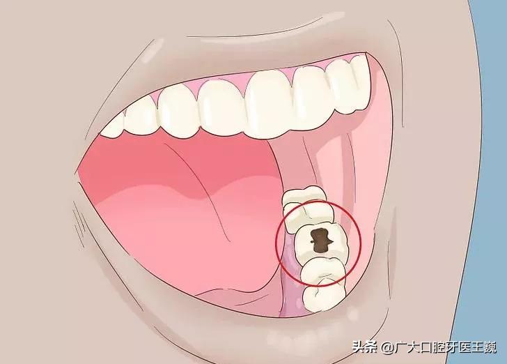 牙齿腐烂要怎么才能修复好,老人的牙齿全部腐烂怎么办