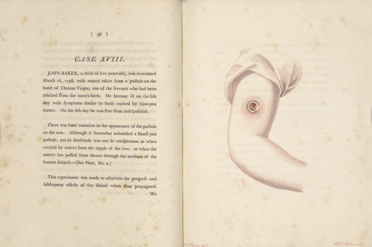 免疫学之父爱德华詹纳治疗天花,免疫学之父爱德华詹纳