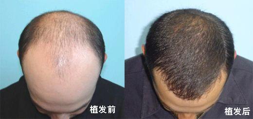 脱发人群25亿,超七成脱发人群不满30岁