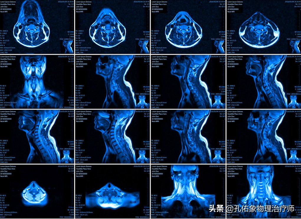颈椎间盘突出手指尖麻乏力怎么治,颈椎间盘突出导致四肢无力疼痛