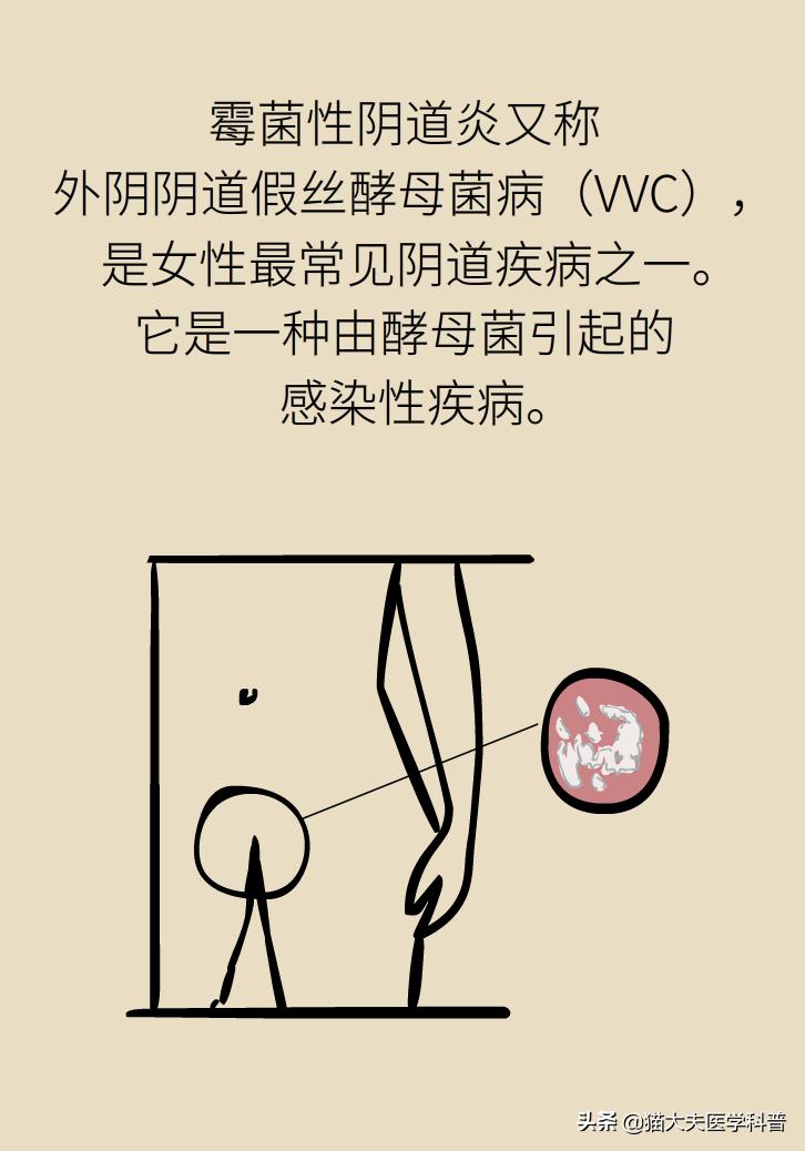 霉菌性阴道炎真的是里面“发霉”了吗？药师教你“抗霉”*法大**