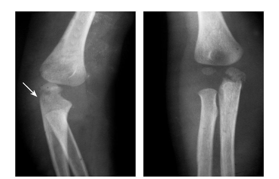 青少年肘部损伤最常见的是,肘部桡神经损伤的临床表现