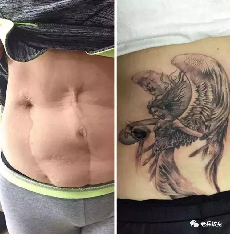 疤痕体质可以用纹身去遮盖疤痕吗,你的疤痕是什么颜色呢