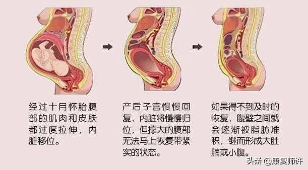 产后腹直肌分离的解决方法,产后腹直肌分离怎么处理