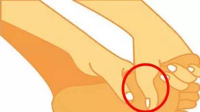 大脚趾外翻怎么锻炼恢复正常,大脚趾外翻矫正危害