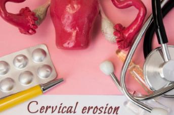 宫颈二度糜烂且检查时出血是癌吗,宫颈糜烂要做什么检查可以查出来