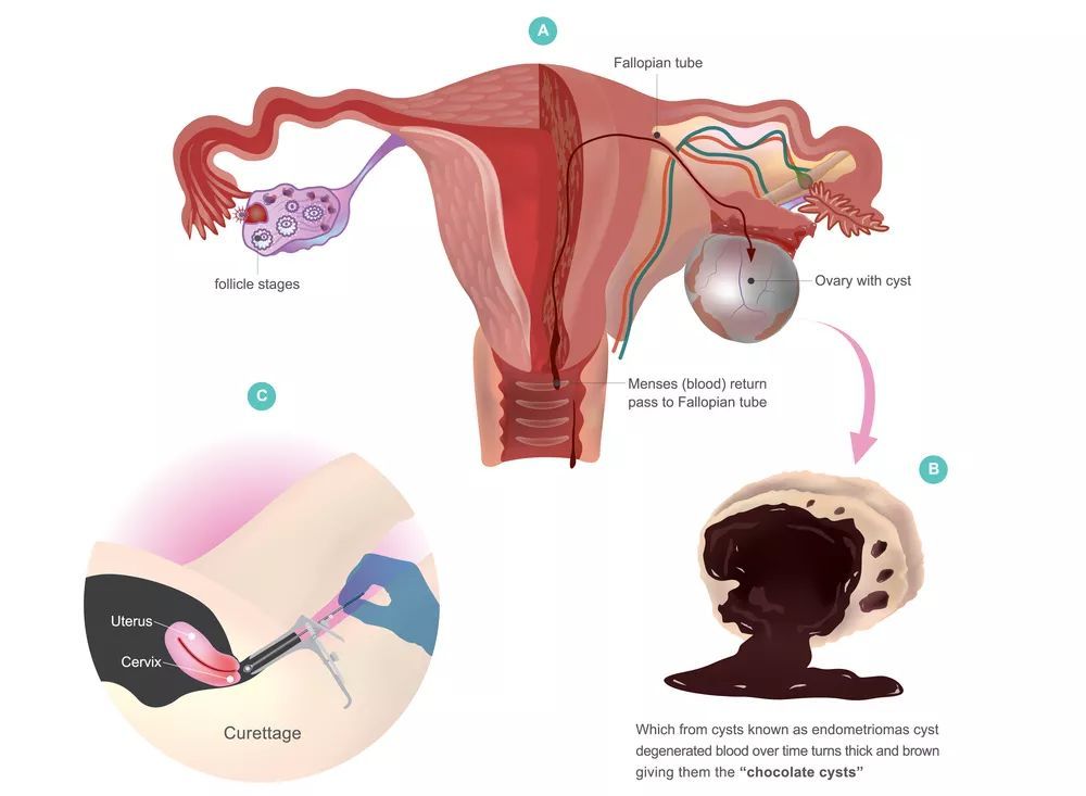 与卵巢巧克力囊肿有关的疾病是,巧克力卵巢囊肿最好的治疗方式