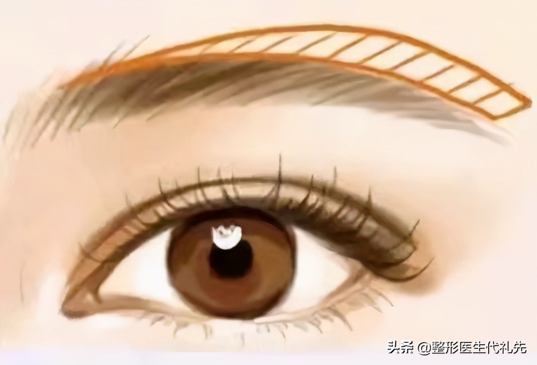 做提眉之前需要注意什么,提眉手术怎么操作