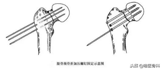 老年人的最后一次骨折,老年人请谨防人生最后一次骨折