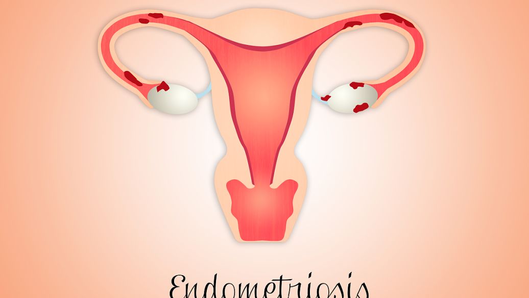 多囊卵巢综合症10年不孕,多囊卵巢综合症一年无措施没怀上