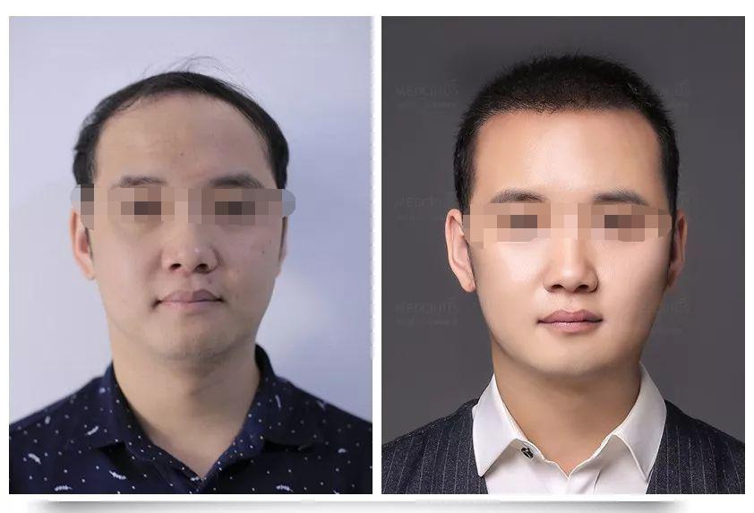 秃顶前兆是不是两边先秃,最好的治中年头秃的办法