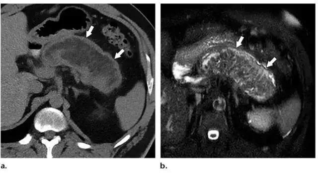 简述急性胰腺炎影像学表现,有关急性胰腺炎疼痛的图片