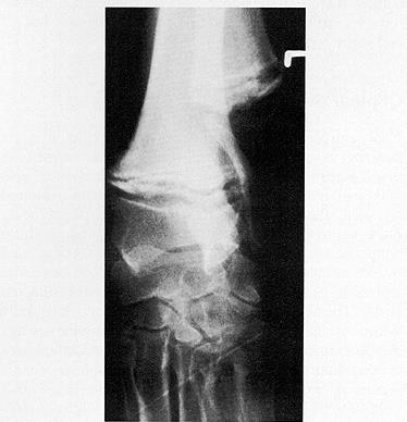 肥大性肌营养不良的症状表现,肥大性肌营养不良怎么办