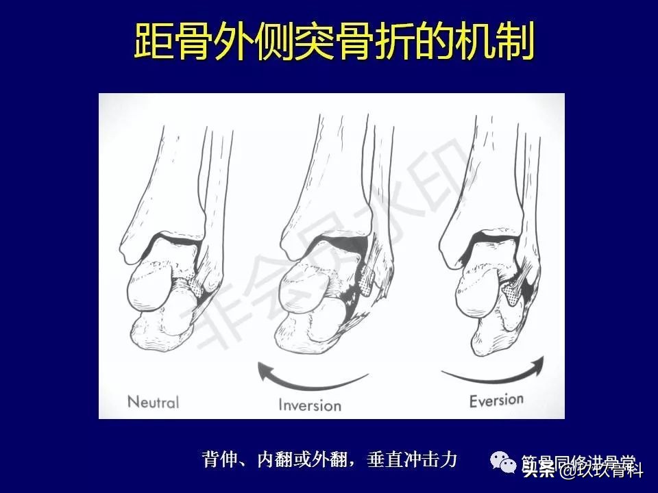 距骨骨折后遗症,距骨骨折怎么办