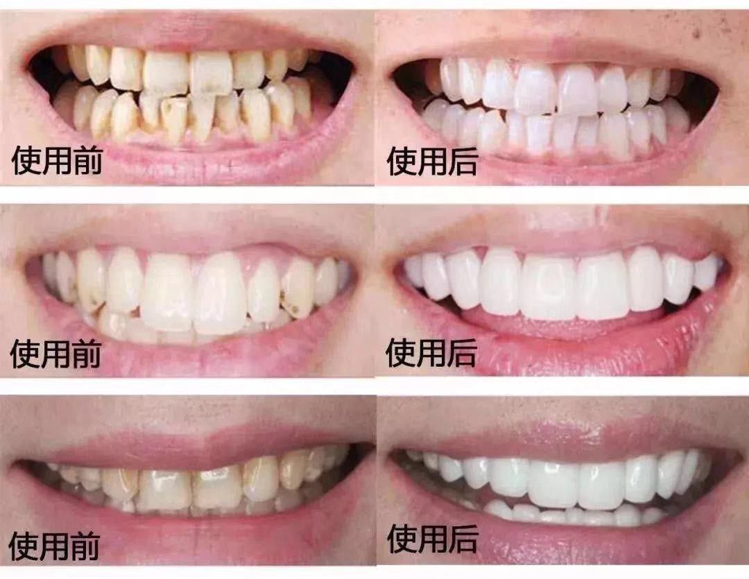 李佳琦巴氏刷牙,李佳琦口嚼式牙膏