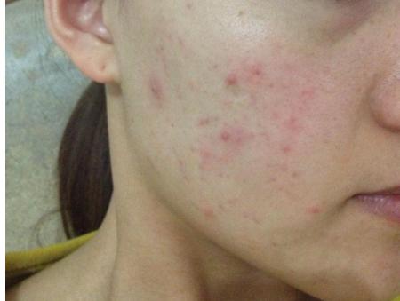 脸上长痘的几种原因,脸上长痘的三种原因