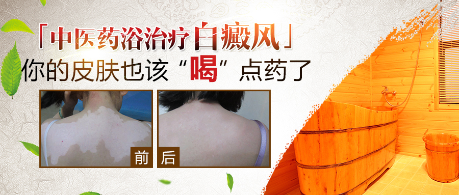 白癜风患者药浴疗法作用大吗,治疗白癜风药浴配方