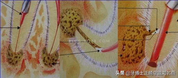 根管治疗难点与解决方案,根管治疗牢固吗