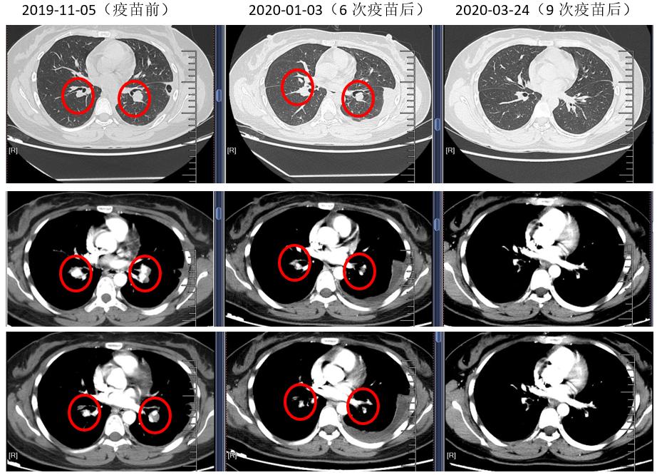 滑膜肉瘤的免疫组化标准,滑膜肉瘤靶向给药