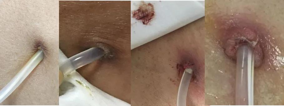 腹膜透析出现腹膜炎的护理措施,腹膜透析居家注意事项