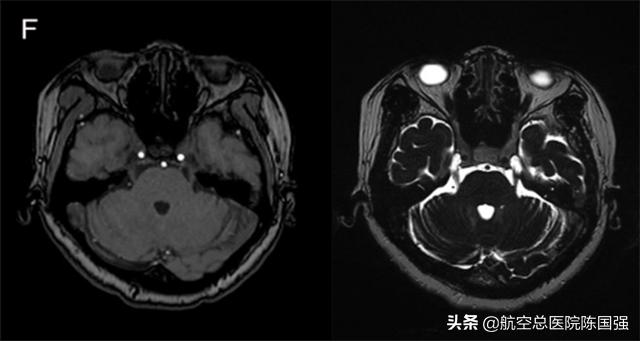 陈国强：令人烦恼的“咬牙切齿”竟是罕见的咬肌痉挛