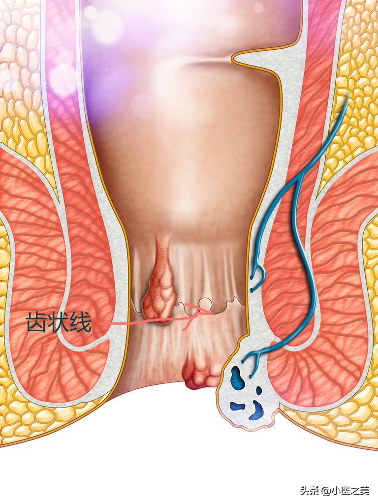 便便后还在滴鲜血，痔疮如何治疗、预防？
