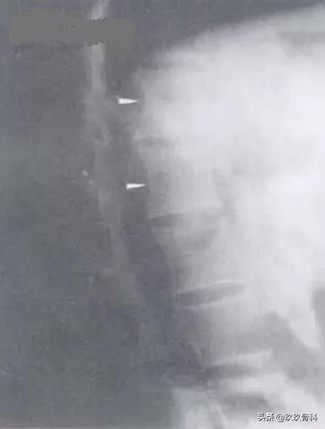 5岁小孩强直性脊柱炎的诊断,强直性脊柱炎诊断标准b27