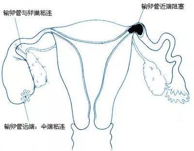 想要个宝宝,却遇上输卵管阻塞,该怎么办?