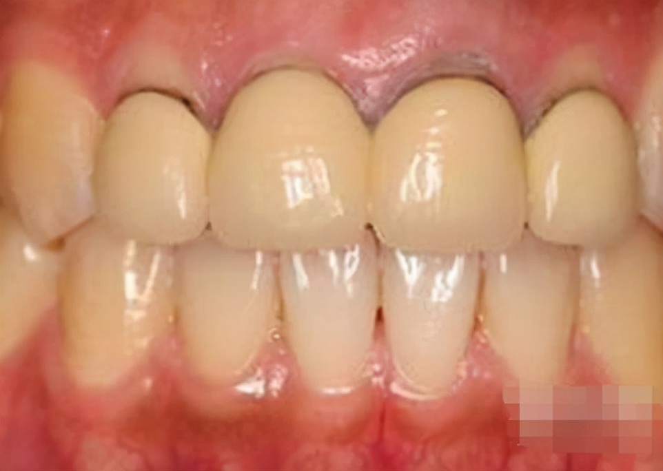 烤瓷牙破冠怎么办,基牙损坏保留烤瓷冠