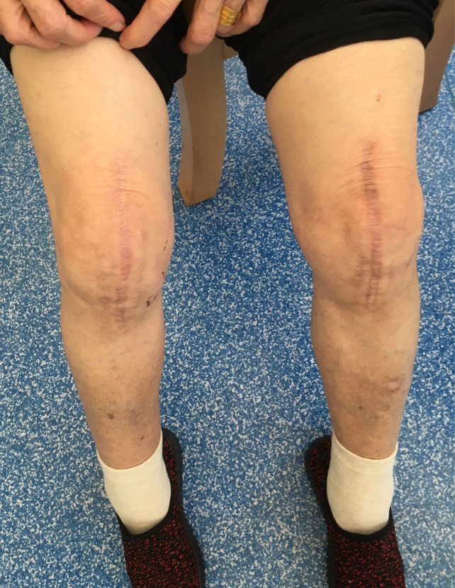 膝关节有骨刺可以手术磨掉吗,膝盖有骨刺增生多久能恢复健康