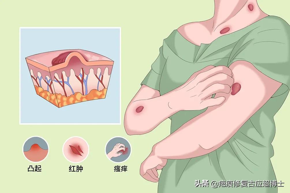 胸口疤痕越长越大怎么回事,手术疤痕越长越大怎么回事