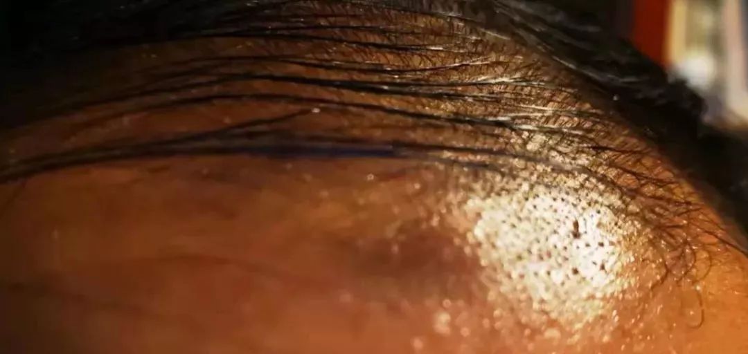 脱发科普宣讲,关于脱发越来越年轻化原因