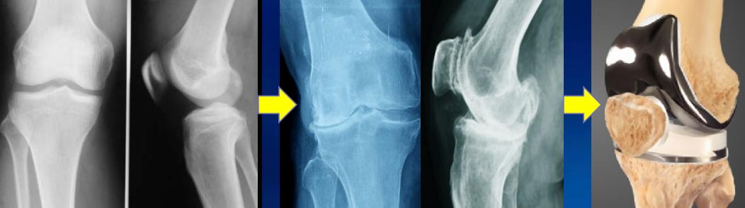 半月板损伤康复训练,半月板损伤膝盖疼的最好治疗方法