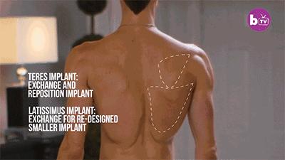 隆胸那些事你真的了解吗,隆胸加腹壁整形