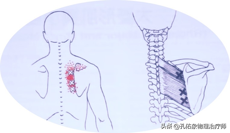 后背肩胛骨疼什么原因造成的,右后背肩胛骨下角疼痛部位对照表