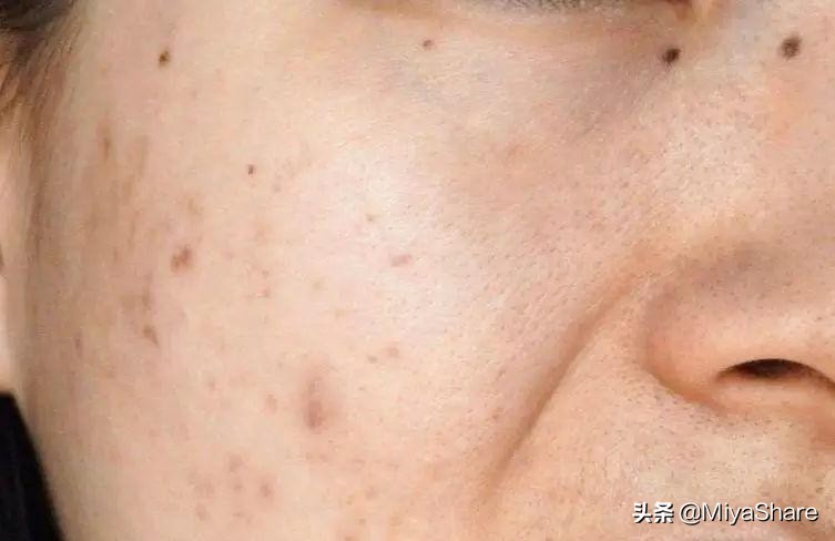 2分钟学会痘印如何快速消除,痘印怎么祛16个祛除痘印的小妙招