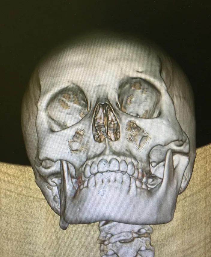 歪脸是什么原因造成的,歪脸怎么治