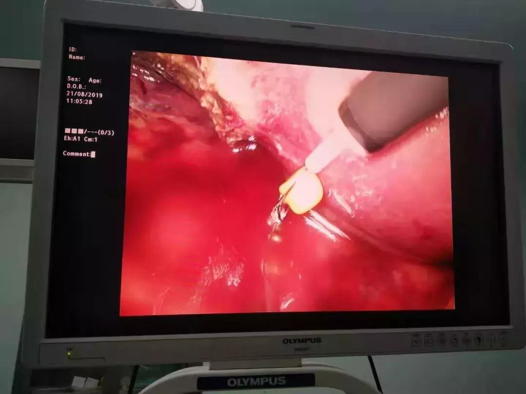 诊断梗阻性黄疸最有效的检查方法,梗阻性黄疸哪种引流方法好