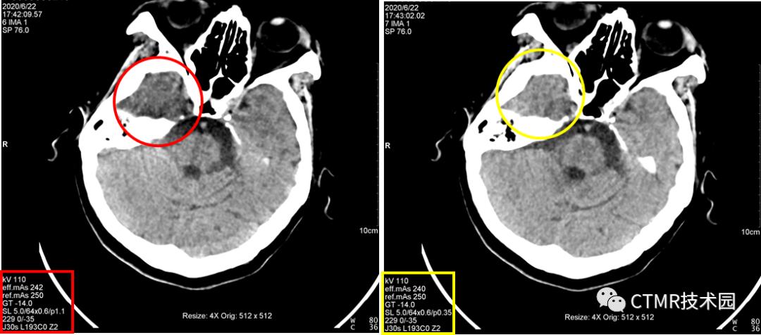 CT影像技术,脑部做ct有伪影是怎么回事
