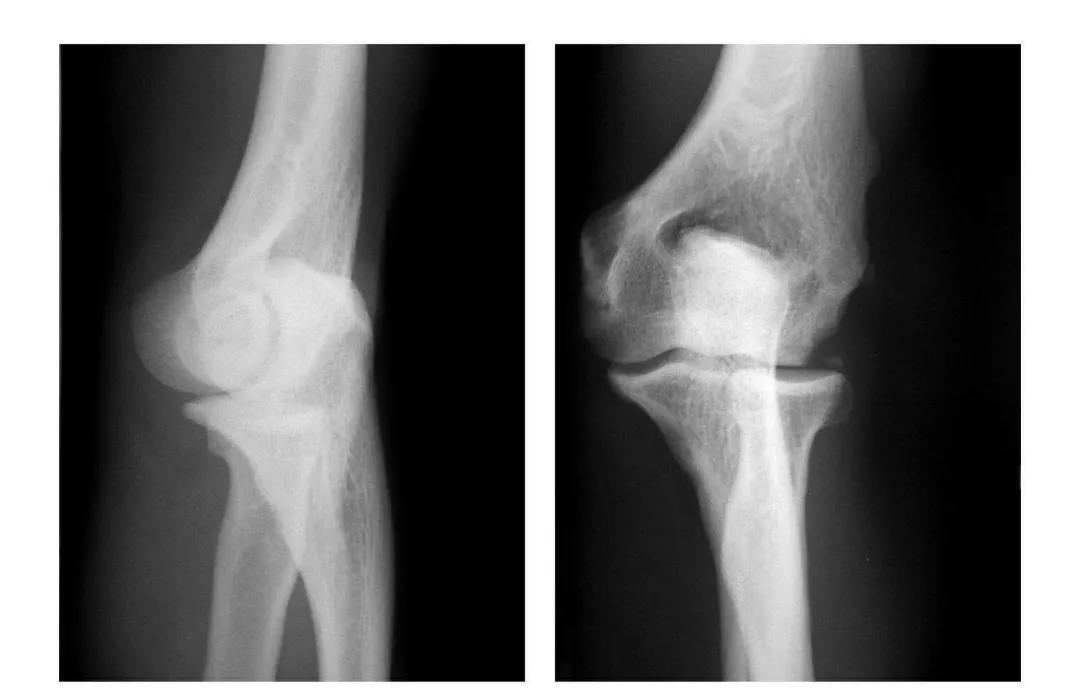 青少年肘部损伤最常见的是,肘部桡神经损伤的临床表现