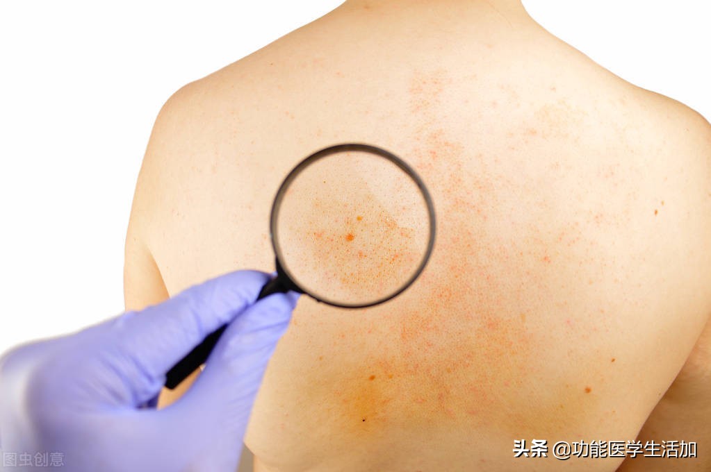 孕晚期肚子湿疹对胎儿有影响吗,孕期严重湿疹会影响胎儿吗