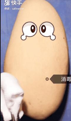 我在快手上看人切洋葱，竟然弄懂了剖腹产？