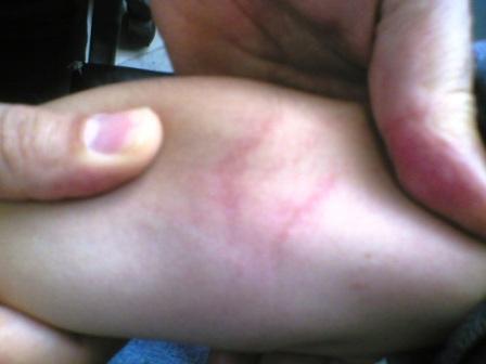 有发热和皮疹别忽视猩红热,猩红热先出红疹后发烧