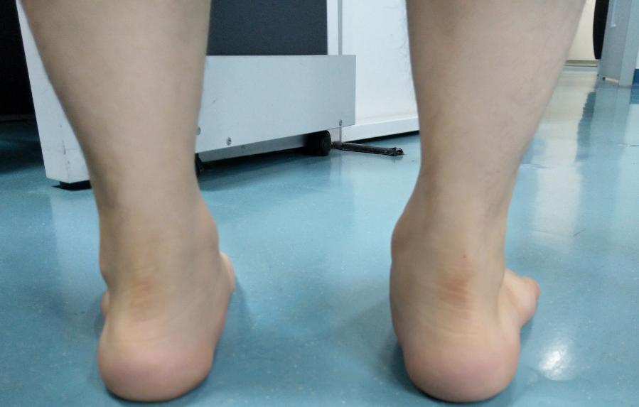 如何通过小动作纠正扁平足,扁平足最佳训练方法